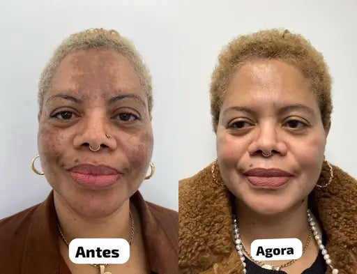😍 Pele Lisa em Apenas 7 dias 😍 MILAGRE da Kojic🔥
