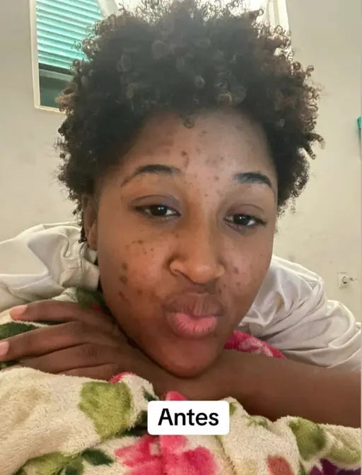 😍 Pele Lisa em Apenas 7 dias 😍 MILAGRE da Kojic🔥