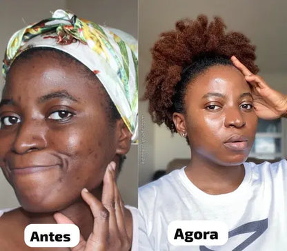 😍 Pele Lisa em Apenas 7 dias 😍 MILAGRE da Kojic🔥